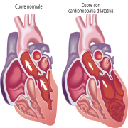 Salute e benessere Cardiomiopatia ipertrofica