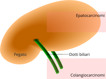 Tumori Tumore Del Fegato Epatocarcinoma